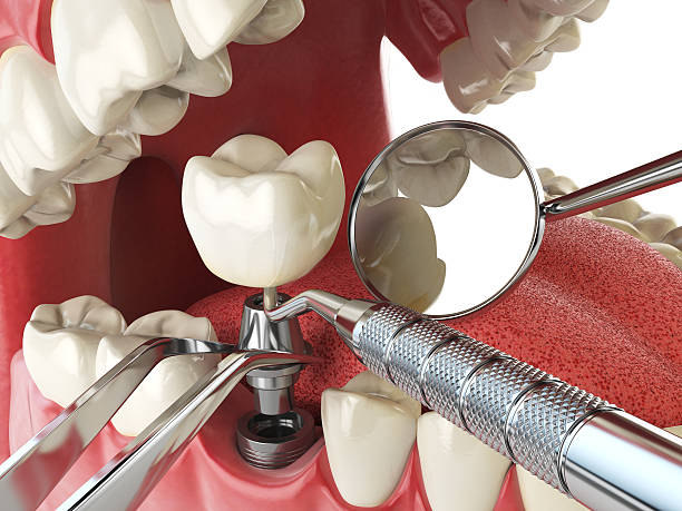 Best Emergency Tooth Extraction in The Dalles, OR